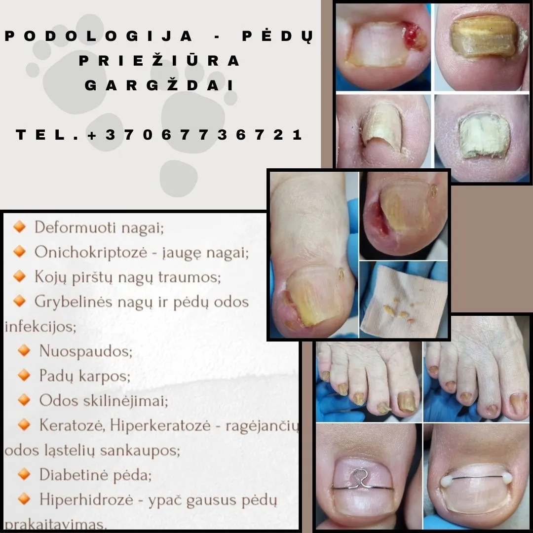 Podologija pėdų priežiūra, Gargždai.